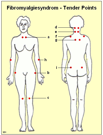 Tender Point bei Fibromyalgiesyndrom - FMS